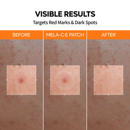 Dr. Melaxin Ultra Thin Pimple Patch Duo Pack (2 x 72 Patches)